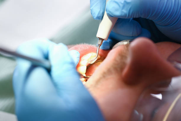 Best Emergency Tooth Extraction in Scottsville, NY